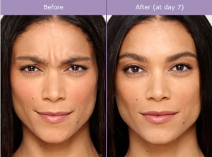 BOTOX® Cosmetic