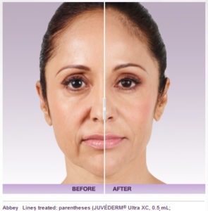 Dermal Fillers