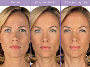 Is BOTOX® Safe?