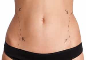 Tummy Tuck Surgery Costs