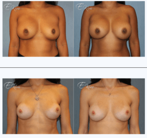 Breast Implants Exchange Surgery Before and After Photos