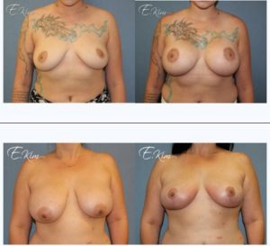 Breast Lift Surgery (Mastopexy) Before and After Photos