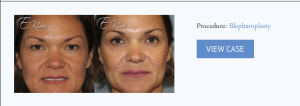 What are Blepharoplasty (Eyelid Surgery) Before and After Photos?