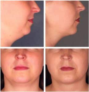 Neck Lift Surgery vs. Kybella Injections