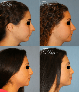 Rhinoplasty