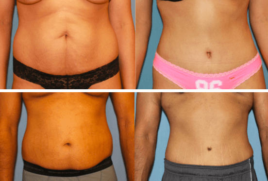 Cost Of Tummy Tuck