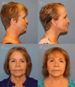 Neck Lift