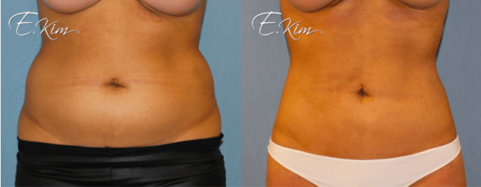 Liposuction