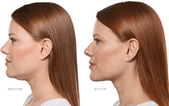 Kybella