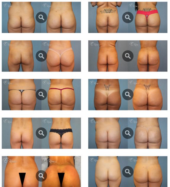 Buttock Implants Enhancement Before And After Photos
