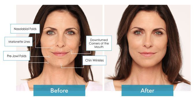 Radiesse Dermal Fillers