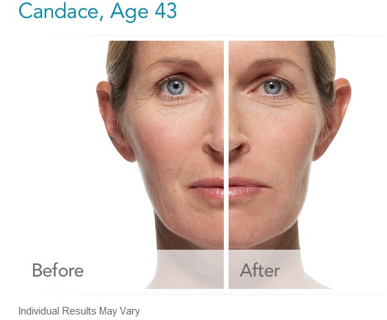How much does Radiesse dermal fillers cost?