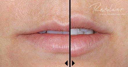 Lip Augmentation With Restylane